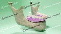 Full arch fixed implant-supported prostheses - Lower arch