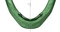 mandibular implant prosthesis - All-on-Four