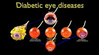 Diabetic eye diseases