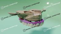 Full arch fixed implant-supported prostheses - Dental implant
