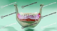 Overdenture lower denture retained by Oring-like abutments