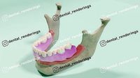Overdenture - Bar-clip lower denture retained by implants