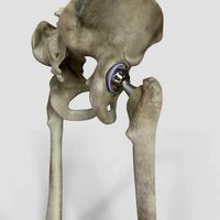 Hip Replacement