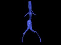 Aortofemoral