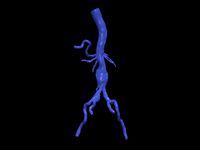 Aortofemoral