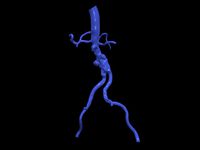 Aortofemoral