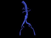 Aortofemoral