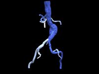 Aortofemoral