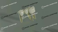Fixed partial denture - Prosthodontics