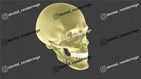 Orthognatic surgery - Titanium plates in the mandible