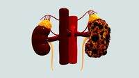 Polycystic Kidney Disease