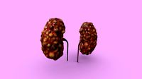 Polycystic kidney