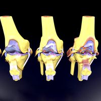 Osteoarthritis stages