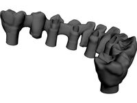 Reduced Mandibula Arcade