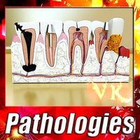 Teeth Pathologies High Detail