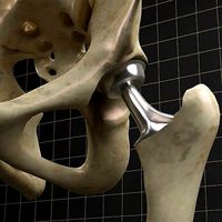 Femoral prosthesis  and  complete skeleton