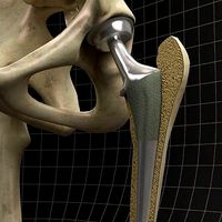Femoral prosthesis with complete skeleton and section femur
