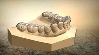 3D Digital B Splints | 3D