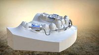 Digital Lip Bumper Appliance | 3D