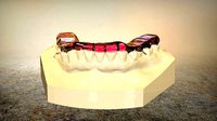 Digital Tanner Splint Orthodontics | 3D