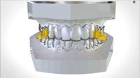 Digital Elastic Mandibular Advancement Device | 3D