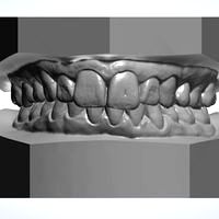 Dental Model