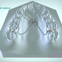Digital Rapid Palatal Expander