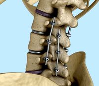 Spinal fixation system - titanium bracket