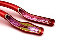 Blood vessel - normal and cholesterol damaged vessel