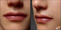 Lips Morphs for G8M Vol 1