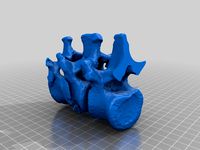 Lumbar Fracture by trauma3d