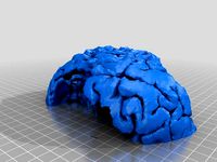 brain mri tumor  by medmega