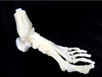 Ankle - Talus fracture by MarioDiniz
