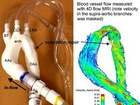 Surgically repaired coarctation of the aorta (flow model) by l8aarx