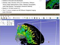 Printable Diffusion MRI analysis Brain tracts  by marcotronic