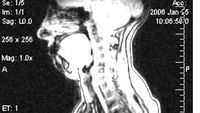 LESIONES VERTEBRALES GRAVES