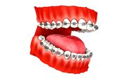 Mouth Teeth Set Braces Brackets
