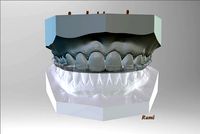 Digital Bite-guard Appliance | 3D